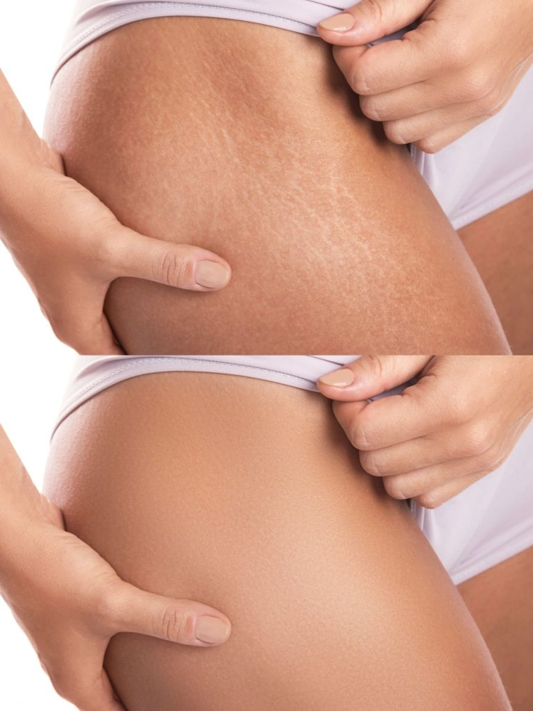 Stretch Marks Treatment