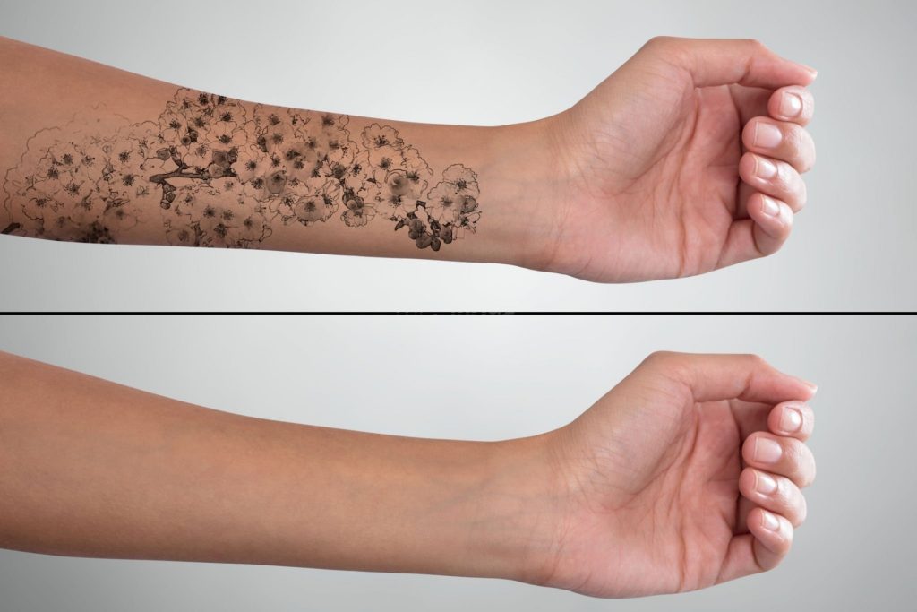 Permanent Laser Tattoo Removal in Jersey City, NJ