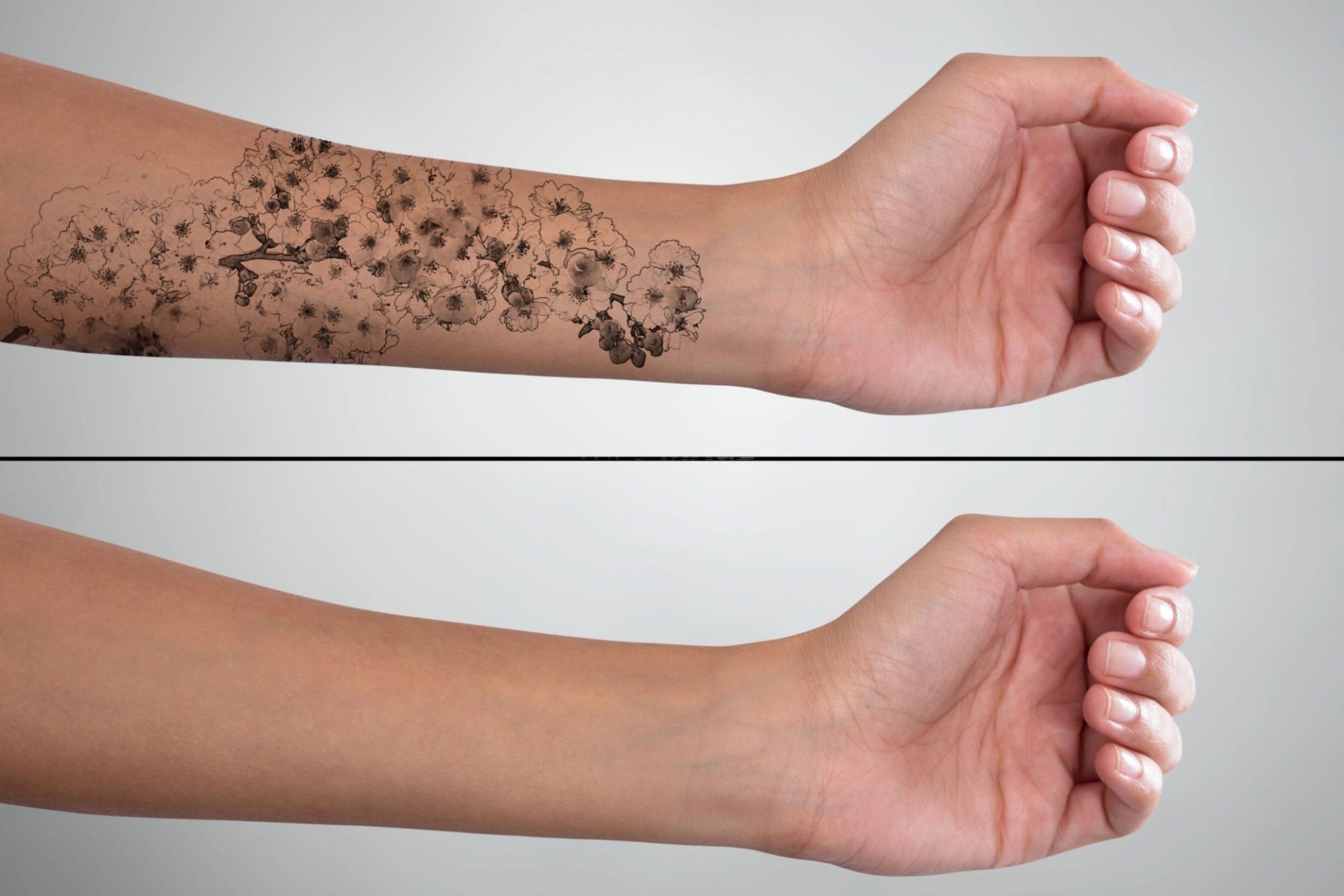 Why does laser tattoo removal cause frosting? - Goodbye Tattoos | Sydney